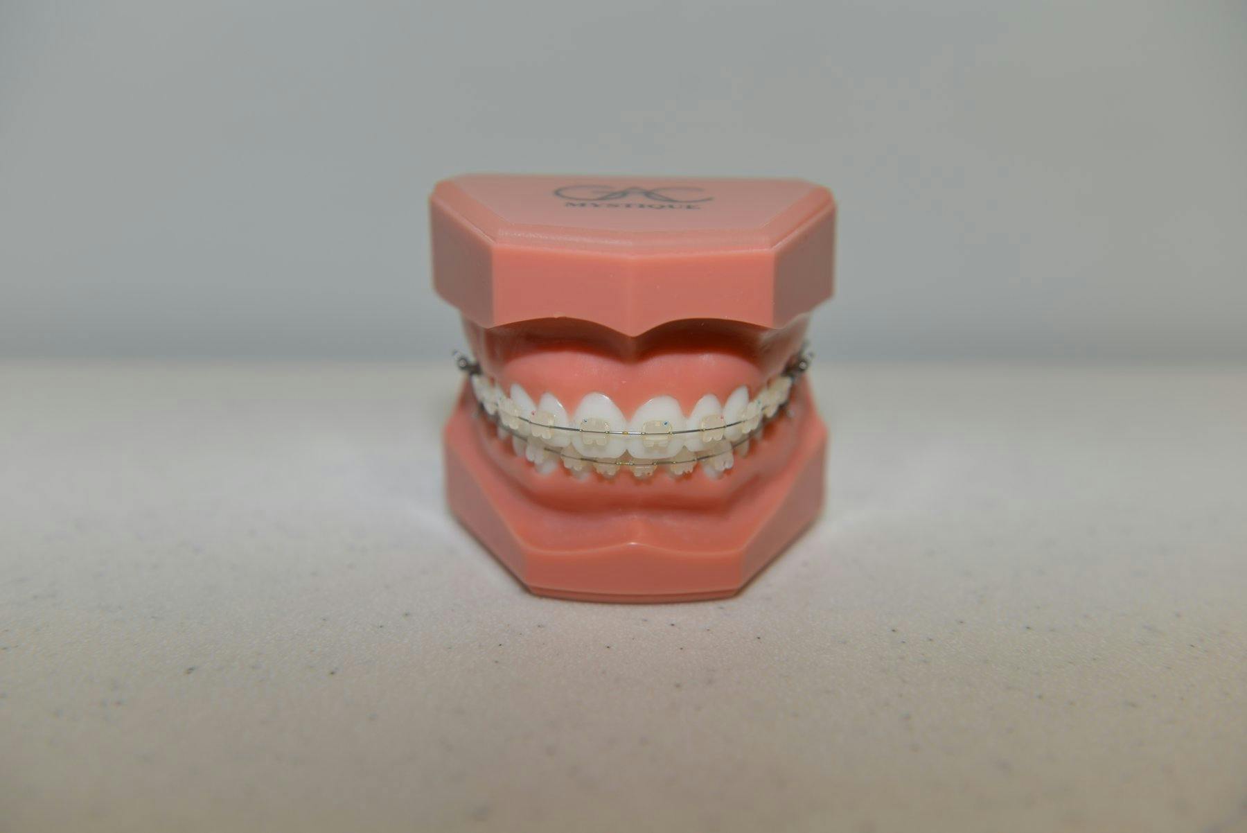 Photo of ceramic braces on a teeth model