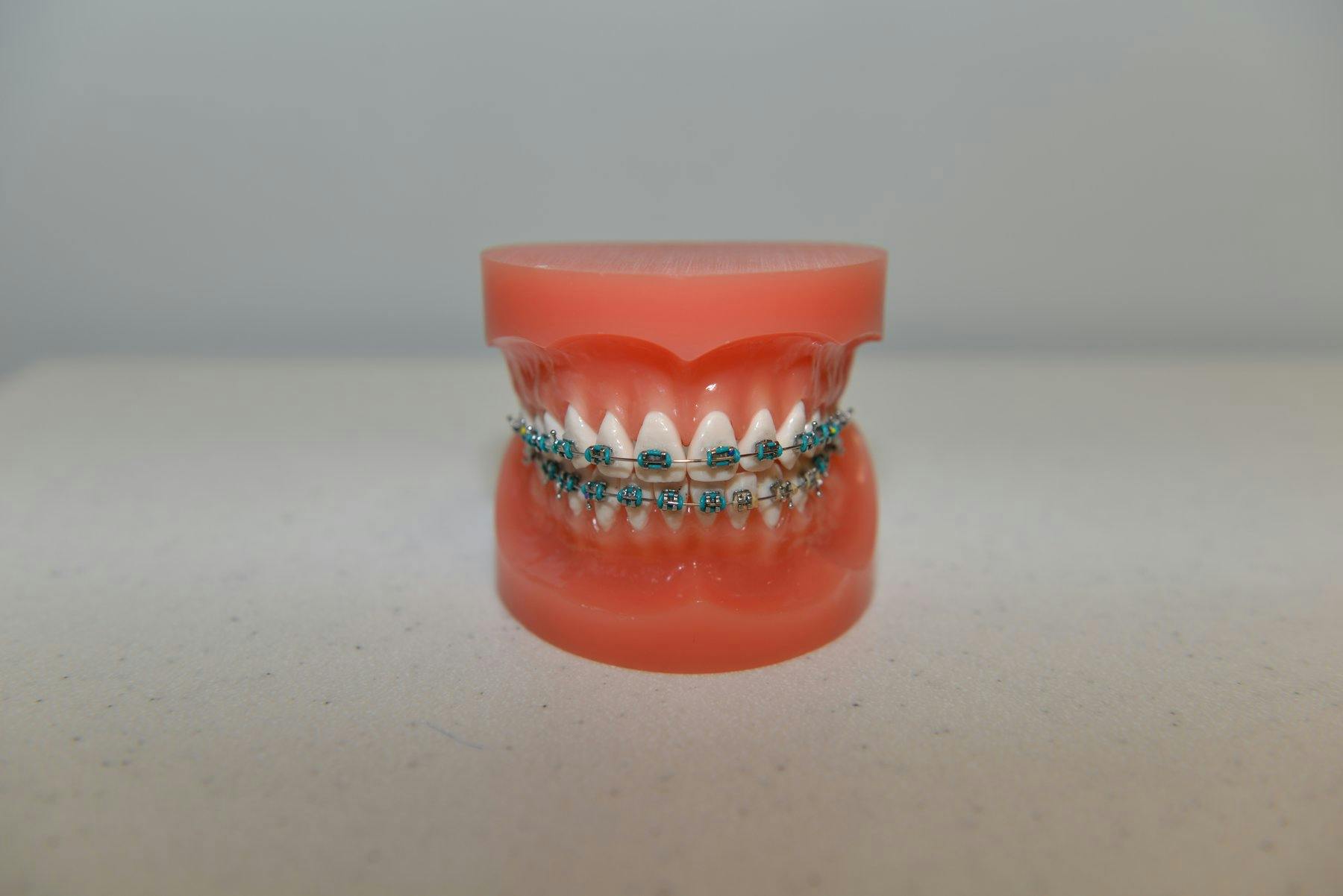 Photo of metal braces on a teeth model