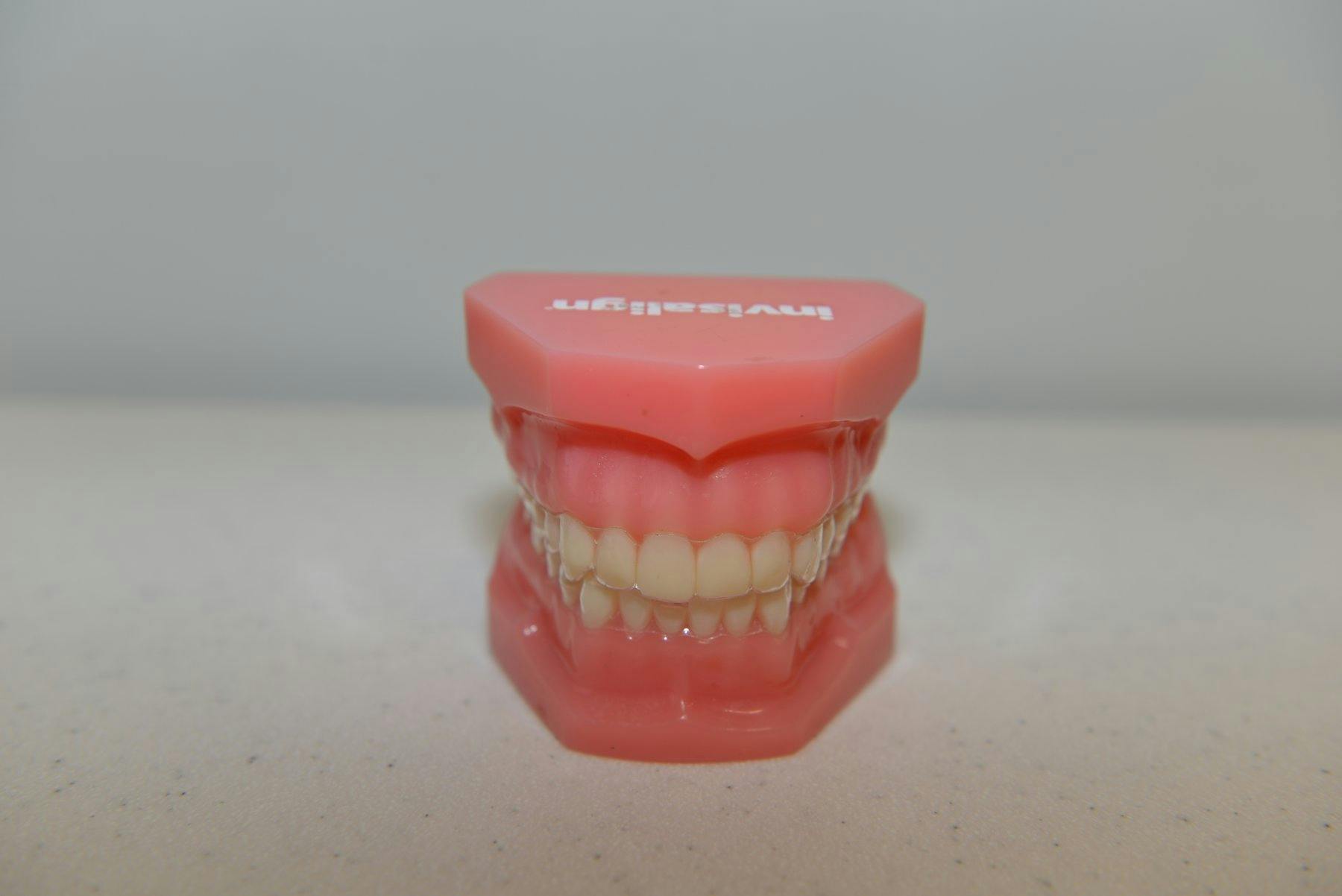 Photo of Invisalign aligners on a teeth model