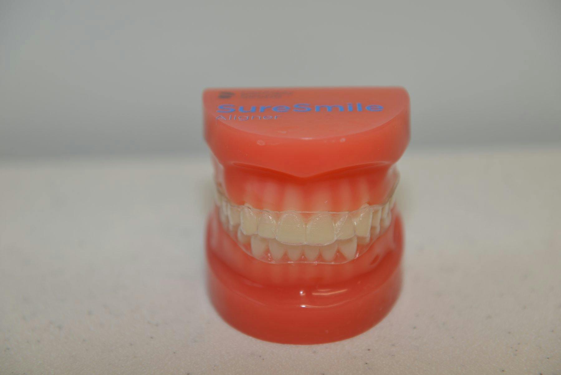 Photo of SureSmile aligners on a teeth model